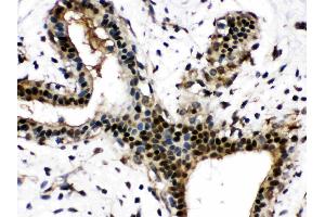 Visfatin was detected in paraffin-embedded sections of human mammary cancer tissues using rabbit anti- Visfatin Antigen Affinity purified polyclonal antibody (Catalog # ) at 1 µg/mL.