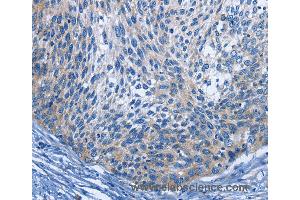 Immunohistochemistry of Human cervical cancer using IL2RB Polyclonal Antibody at dilution of 1:30 (IL2 Receptor beta anticorps)