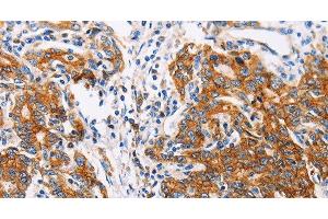 Immunohistochemistry of paraffin-embedded Human gastic cancer using CTNNA1 Polyclonal Antibody at dilution of 1:35 (CTNNA1 anticorps)