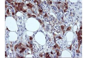 Immunohistochemical staining of paraffin-embedded Carcinoma of Human pancreas tissue using anti-SERPINB2 mouse monoclonal antibody. (SERPINB2 anticorps)
