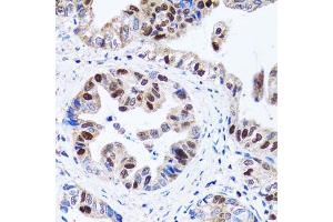 Immunohistochemistry of paraffin-embedded human gastric cancer using UHRF1 antibody. (UHRF1 anticorps)