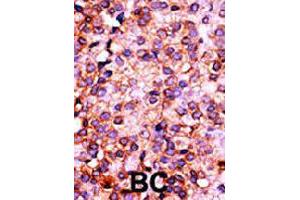 Formalin-fixed and paraffin-embedded human cancer tissue reacted with PANK3 polyclonal antibody  , which was peroxidase-conjugated to the secondary antibody, followed by AEC staining. (PANK3 anticorps  (N-Term))