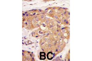 Formalin-fixed and paraffin-embedded human breast carcinoma tissue reacted with SOST polyclonal antibody  , which was peroxidase-conjugated to the secondary antibody, followed by DAB staining. (Sclerostin anticorps  (N-Term))