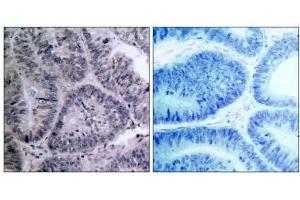 Immunohistochemical analysis of paraffin-embedded human colon carcinoma tissue, using IKKα (Ab-23) antibody (E021123). (IKK alpha anticorps)