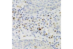 Immunohistochemistry of paraffin-embedded human lung cancer using GEMIN2 Antibody. (SIP1 anticorps)