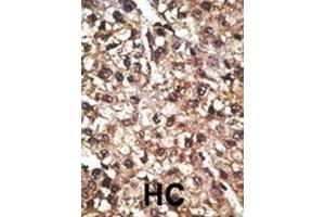Formalin-fixed and paraffin-embedded human cancer tissue reacted with the primary antibody, which was peroxidase-conjugated to the secondary antibody, followed by AEC staining.