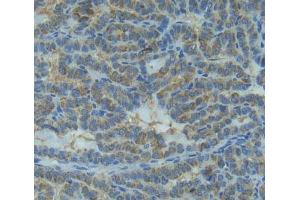 IHC-P analysis of thyroid cancer tissue, with DAB staining. (IL1RN anticorps  (AA 26-177))