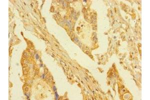Immunohistochemistry of paraffin-embedded human pancreatic cancer using ABIN7165304 at dilution of 1:100 (DPY30 anticorps  (AA 1-99))