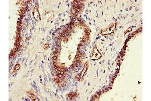 Immunohistochemistry of paraffin-embedded human prostate cancer using ABIN7170330 at dilution of 1:100