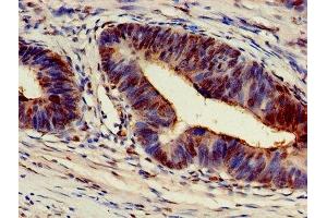 Immunohistochemistry of paraffin-embedded human colon cancer using ABIN7143447 at dilution of 1:100 (ARF4 anticorps  (AA 1-180))