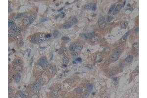 Detection of CX3CL1 in Human Breast cancer Tissue using Polyclonal Antibody to Chemokine C-X3-C-Motif Ligand 1 (CX3CL1)