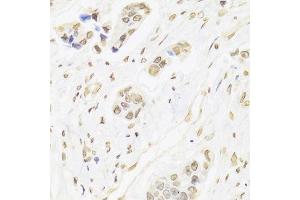 Immunohistochemistry of paraffin-embedded human breast cancer using XRCC6 Antibody.