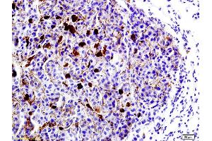 Formalin-fixed and paraffin embedded mouse lung cancer labeled with Anti-LRP1/CD91 Polyclonal Antibody, Unconjugated (ABIN748988) at 1:200 followed by conjugation to the secondary antibody and DAB staining (LRP1 anticorps  (AA 4451-4545))