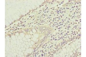 Immunohistochemistry of paraffin-embedded human colon cancer using ABIN7156905 at dilution of 1:100 (IL1F9 anticorps  (AA 1-169))