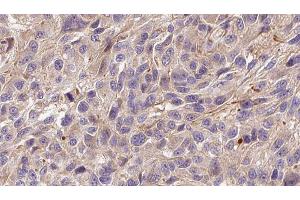 ABIN6272299 at 1/100 staining Human Melanoma tissue by IHC-P. (FGF22 anticorps  (Internal Region))