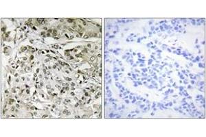 Immunohistochemistry analysis of paraffin-embedded human breast carcinoma tissue, using TAF1 Antibody. (TAF1 anticorps  (AA 1131-1180))