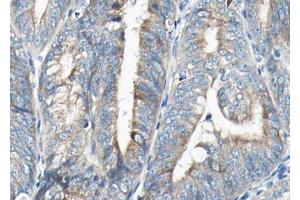 ABIN6268798 at 1/100 staining human Endometrial cancer tissue sections by IHC-P. (VEGFB anticorps  (Internal Region))