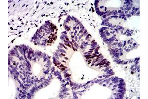 Immunohistochemical analysis of paraffin-embedded colon cancer tissues using MSH6 mouse mAb with DAB staining.