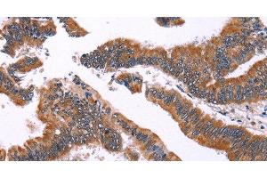 Immunohistochemistry of paraffin-embedded Human colon cancer using IRAK1BP1 Polyclonal Antibody at dilution of 1:40 (IRAK1BP1 anticorps)