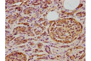IHC image of ABIN7150498 diluted at 1:400 and staining in paraffin-embedded human pancreatic cancer performed on a Leica BondTM system.