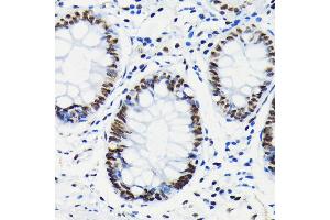 Immunohistochemistry of paraffin-embedded human colon using Phospho-Rb-S780 antibody (ABIN7269936) at dilution of 1:100 (40x lens). (Retinoblastoma 1 anticorps  (pSer780))