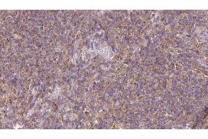 ABIN6273154 at 1/100 staining Human lymph cancer tissue by IHC-P.