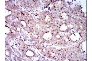 Immunohistochemical analysis of paraffin-embedded cervical cancer tissues using MRPL42 mouse mAb with DAB staining. (MRPL42 anticorps  (AA 142-203))