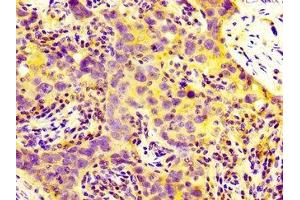 IHC image of ABIN7159247 diluted at 1:300 and staining in paraffin-embedded human pancreatic cancer performed on a Leica BondTM system. (MIA2 anticorps  (AA 178-354))