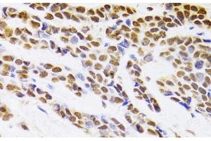 Immunohistochemistry of paraffin-embedded Human breast cancer using HDGF Polyclonal Antibody at dilution of 1:100 (40x lens). (HDGF anticorps)