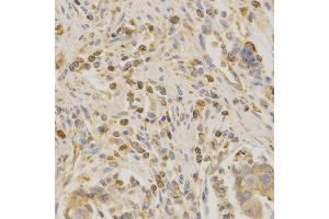 Immunohistochemistry of paraffin-embedded human stomach cancer using BAK1 antibody (ABIN6291815) at dilution of 1:200 (40x lens). (BAK1 anticorps)