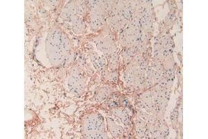 IHC-P analysis of Human Esophagus Cancer Tissue, with DAB staining.
