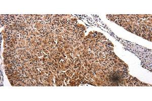 Immunohistochemistry of paraffin-embedded Human renal cancer tissue using RAB41 Polyclonal Antibody at dilution 1:100 (RAB41 anticorps)