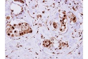 IHC-P Image ERH antibody detects ERH protein at cytosol on human breast cancer by immunohistochemical analysis. (ERH anticorps  (Center))