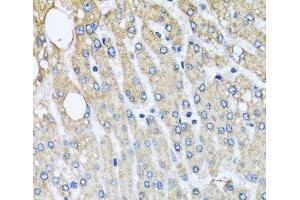 Immunohistochemistry of paraffin-embedded Human liver damage using UQCRC2 Polyclonal Antibody at dilution of 1:100 (40x lens).