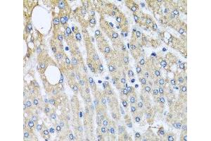 Immunohistochemistry of paraffin-embedded Human liver damage using UQCRC2 Polyclonal Antibody at dilution of 1:100 (40x lens). (UQCRC2 anticorps)