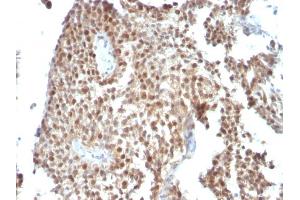 Formalin-fixed, paraffin-embedded human Bladder Carcinoma stained with p53 Monoclonal Antibody (SPM590) (p53 anticorps)