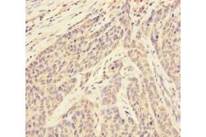 Immunohistochemistry of paraffin-embedded human ovarian cancer using ABIN7170628 at dilution of 1:100 (RBM17 anticorps  (AA 1-240))