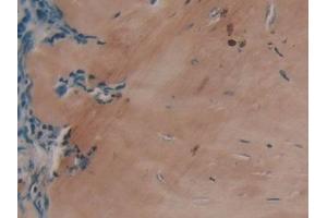 Detection of COL1a1 in Human Lung cancer Tissue using Polyclonal Antibody to Collagen Type I Alpha 1 (COL1a1)