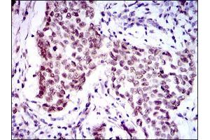 Immunohistochemical analysis of paraffin-embedded breast cancer tissues using FOXP1 mouse mAb with DAB staining.