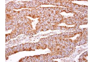 IHC-P Image PACSIN2 antibody [N2C3] detects PACSIN2 protein at cytosol on human colon carcinoma by immunohistochemical analysis. (PACSIN2 anticorps)