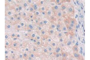DAB staining on IHC-P; Samples: Human Liver cancer Tissue