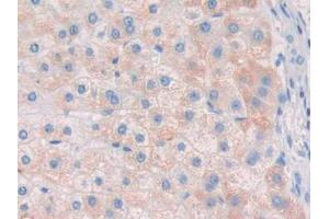DAB staining on IHC-P; Samples: Human Liver cancer Tissue (RNASE8 anticorps  (AA 19-154))