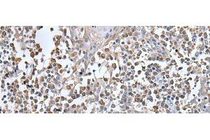 Immunohistochemistry of paraffin-embedded Human tonsil tissue using UBN1 Polyclonal Antibody at dilution of 1:130(x200) (Ubinuclein 1 anticorps)