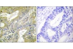 Immunohistochemistry analysis of paraffin-embedded human colon carcinoma tissue, using HEXB Antibody. (HEXB anticorps  (AA 481-530))