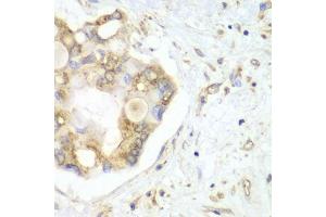 Immunohistochemistry of paraffin-embedded human liver cancer using VTI1B antibody (ABIN6132781, ABIN6150162, ABIN6150163 and ABIN6222854) at dilution of 1:100 (40x lens). (VTI1B anticorps  (AA 1-210))