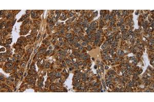 Immunohistochemistry of paraffin-embedded Human ovarian cancer tissue using NEFH Polyclonal Antibody at dilution 1:40 (NEFH anticorps)