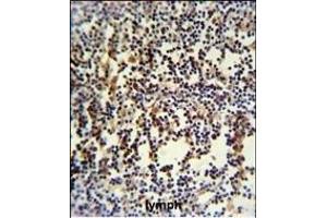 ANR49 Antibody (Center) (ABIN651157 and ABIN2840103) IHC analysis in formalin fixed and paraffin embedded human lymph carcinoma followed by peroxidase conjugation of the secondary antibody and DAB staining.