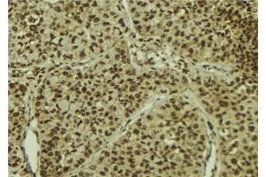 ABIN6278395 at 1/100 staining Human breast cancer tissue by IHC-P. (MGEA5 anticorps)