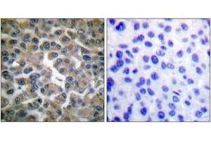 Immunohistochemistry analysis of paraffin-embedded human breast carcinoma tissue, using IkappaB-epsilon (Ab-22) Antibody. (IkappaB-epsilon anticorps  (AA 131-180))