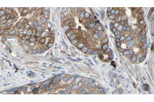 ABIN6274467 at 1/100 staining Human prostate tissue by IHC-P. (PMEPA1 anticorps  (Internal Region))